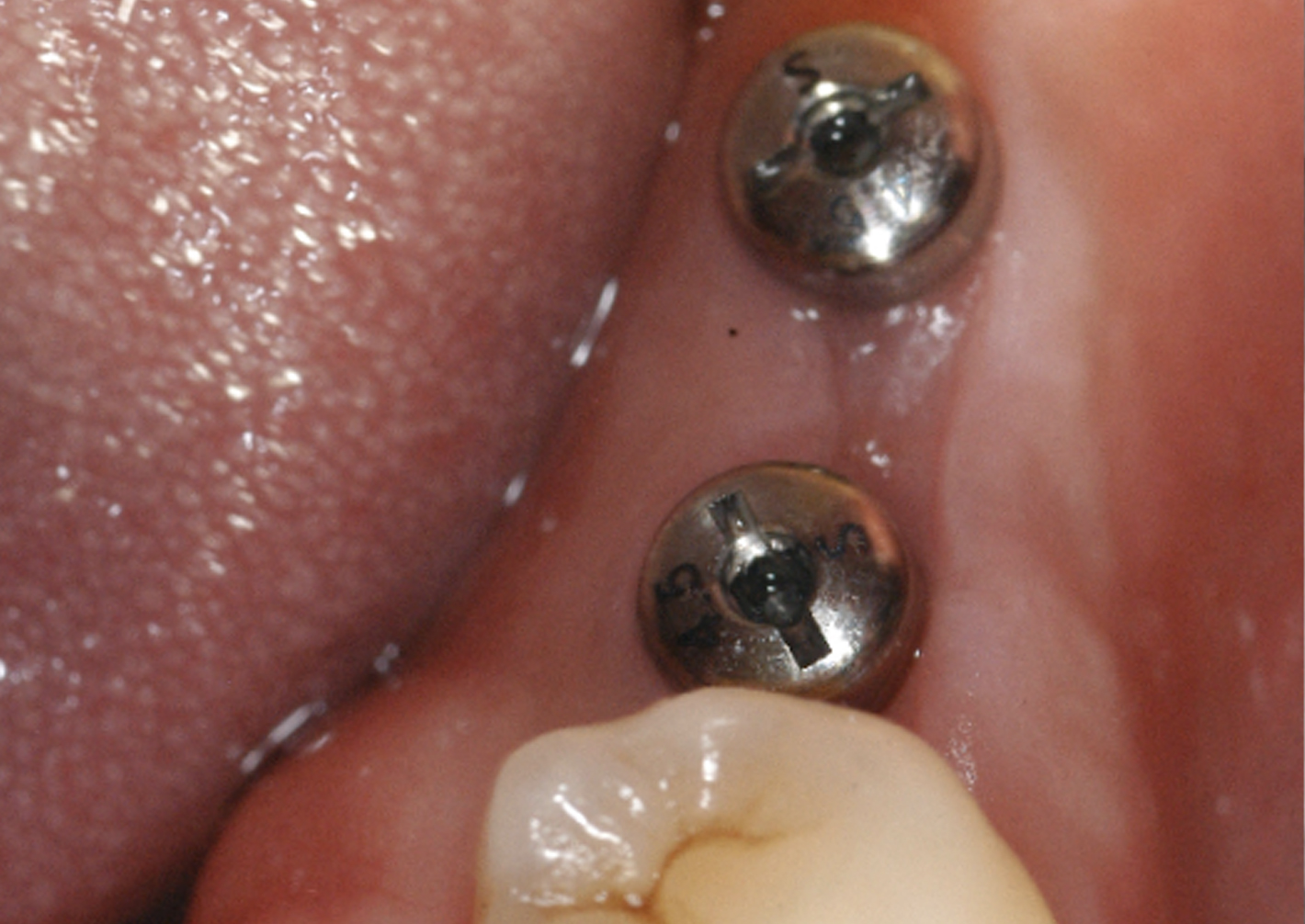 Dental implant in jawbone