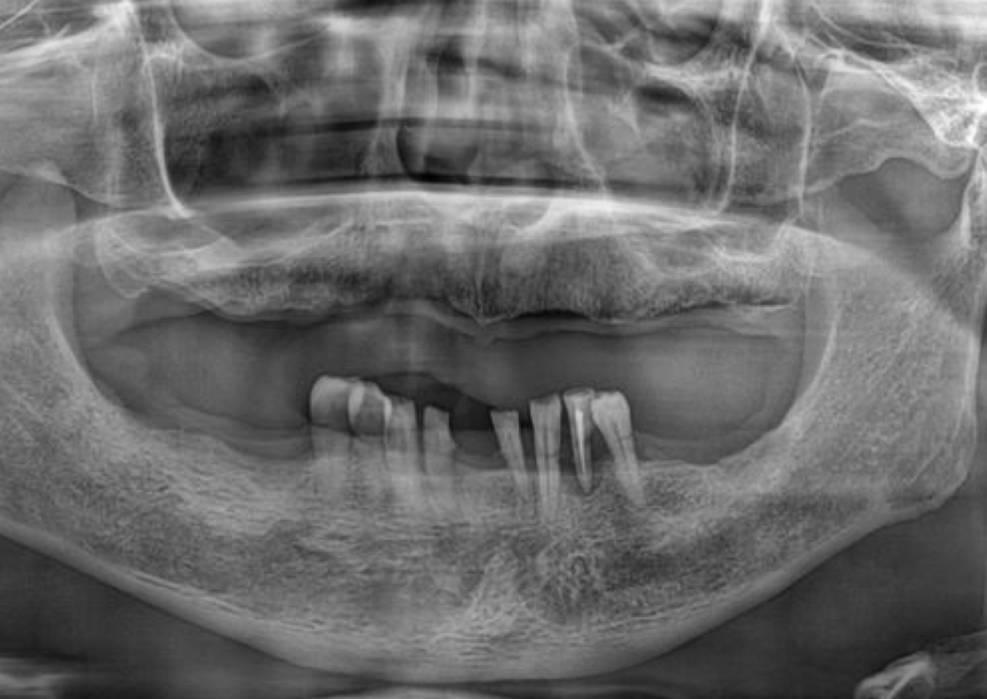 Dental X-ray after procedure 1