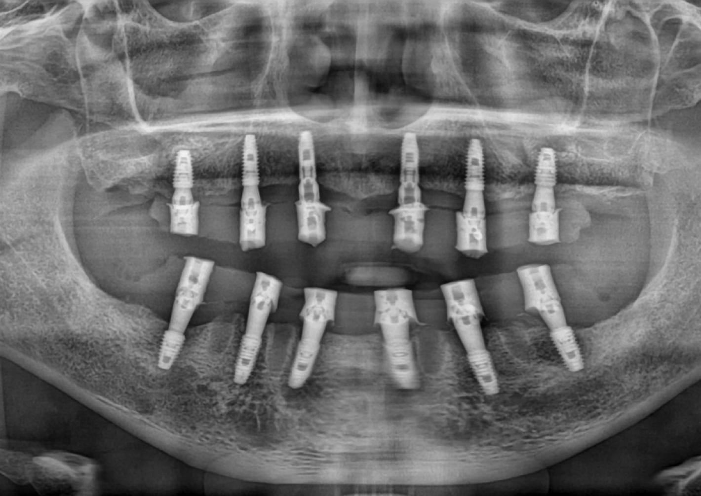 Dental X-ray after procedure 2