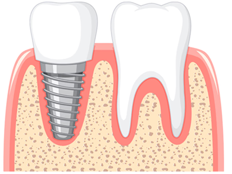 Implant Procedure Steps 1-5