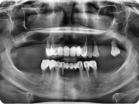 Dental X-ray after procedure 1