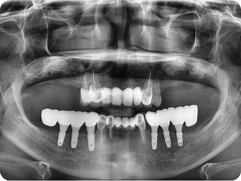 Dental X-ray after procedure 2